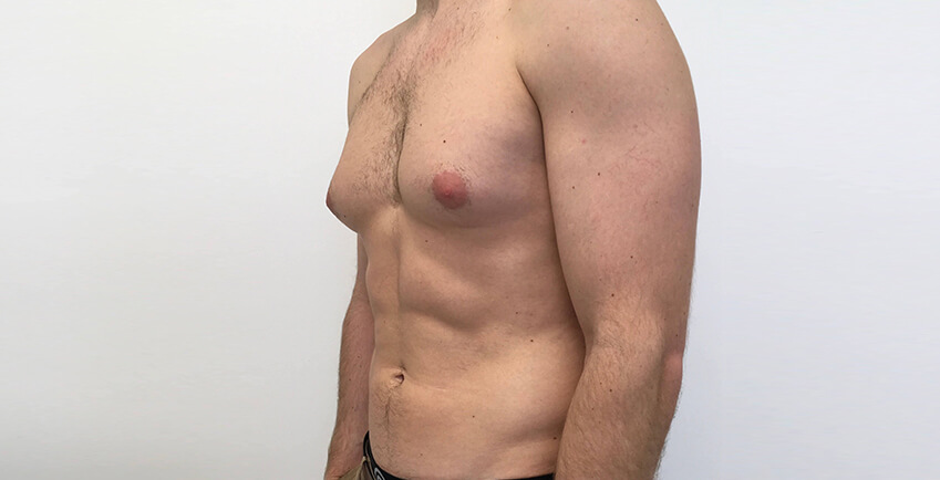 Gynecomastia