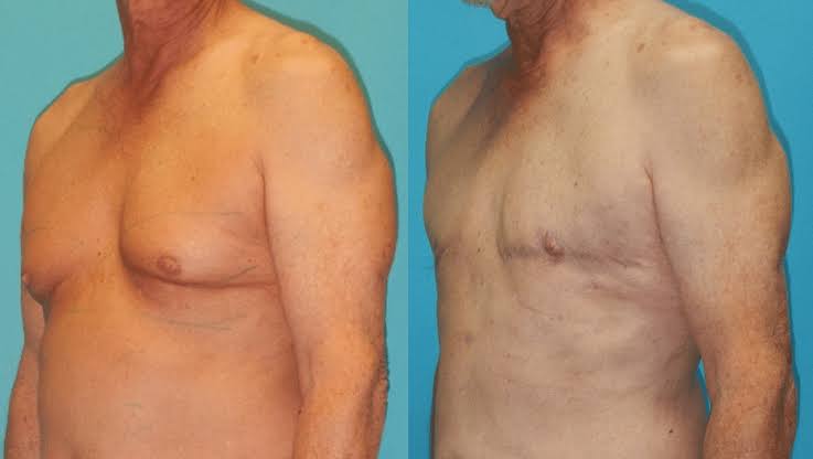 Gynecomastia Treatment