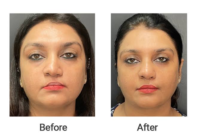 Rhinoplasty Surgery