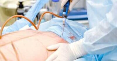 Liposuction Treatment